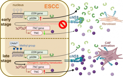 Decreased plasma gelsolin fosters a fibrotic tumor microenvironment and promotes chemoradiotherapy resistance in esophageal squamous cell carcinoma